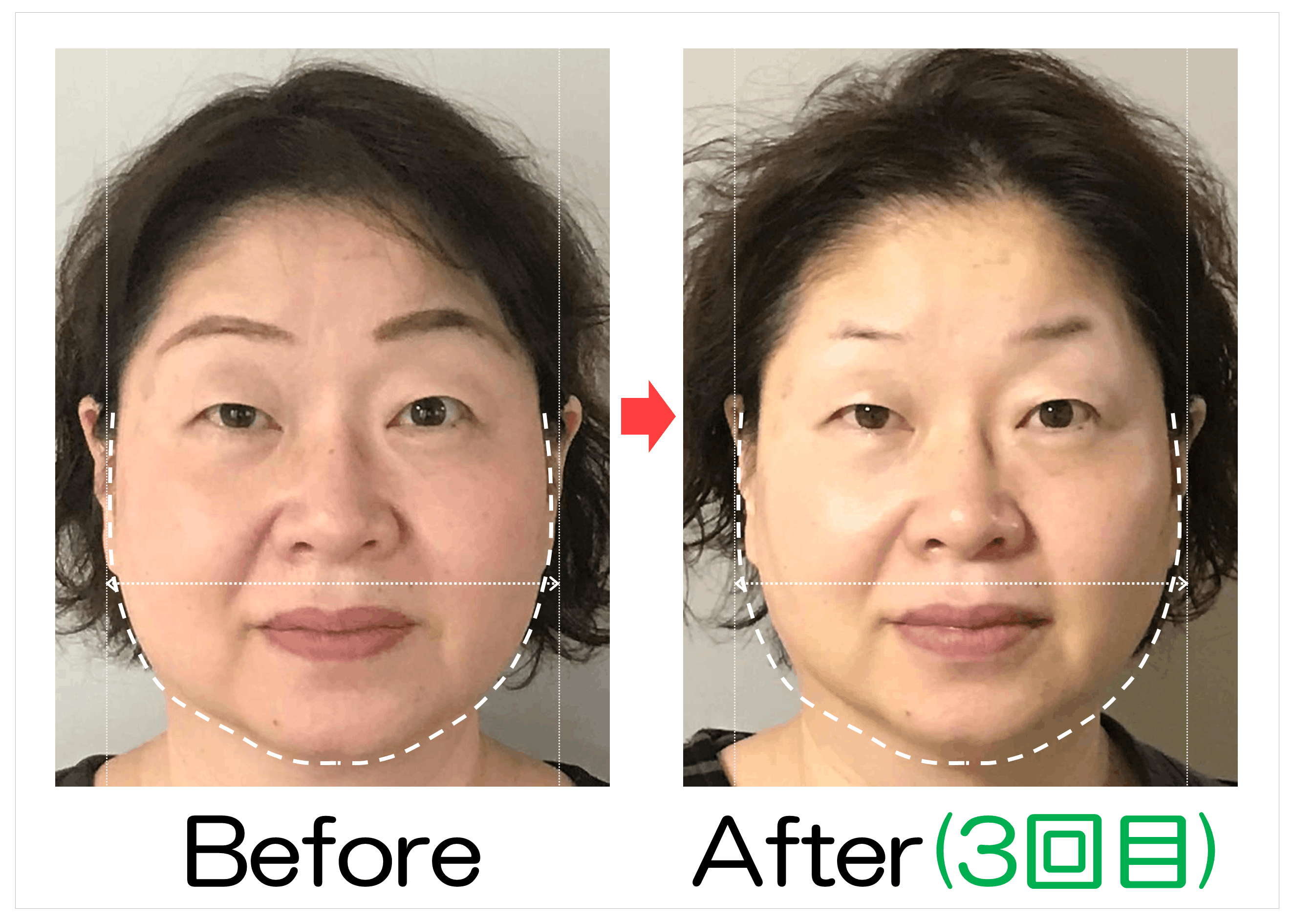 頬の広がりとフェイスラインのBefore・After(3回目)比較
