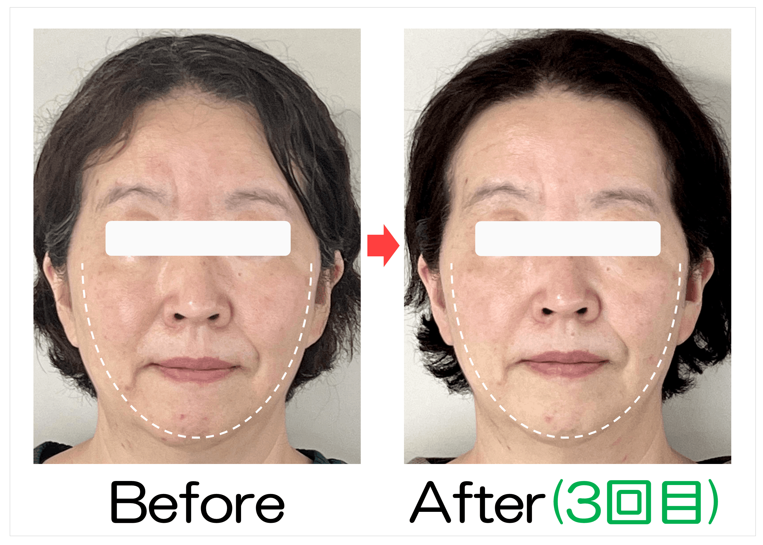 50代女性の卵型ラインBefore・After(3回目)比較