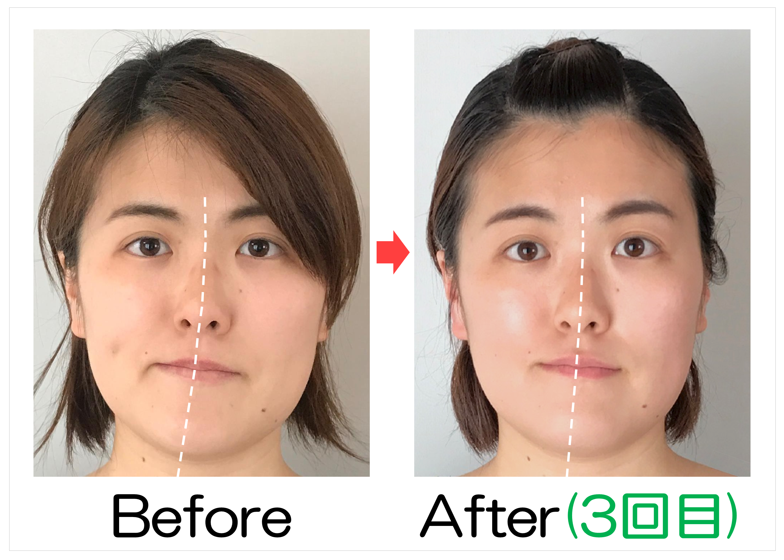 鼻筋からあごの位置のBefore・After(3回目)比較