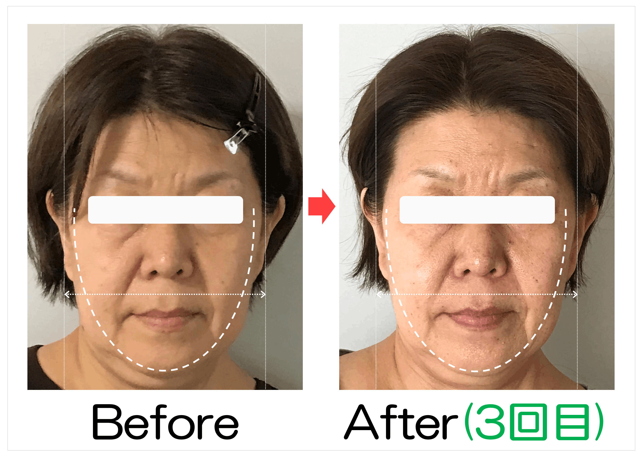 卵型ラインと輪郭のBefore・After(3回目)比較