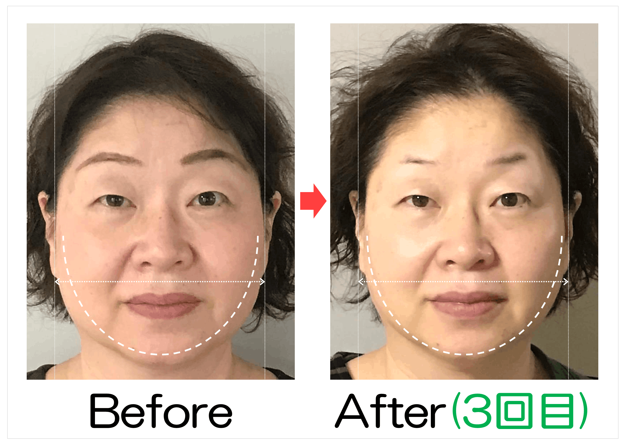頬からあごの輪郭と卵型ラインのBefore・After(3回目)比較