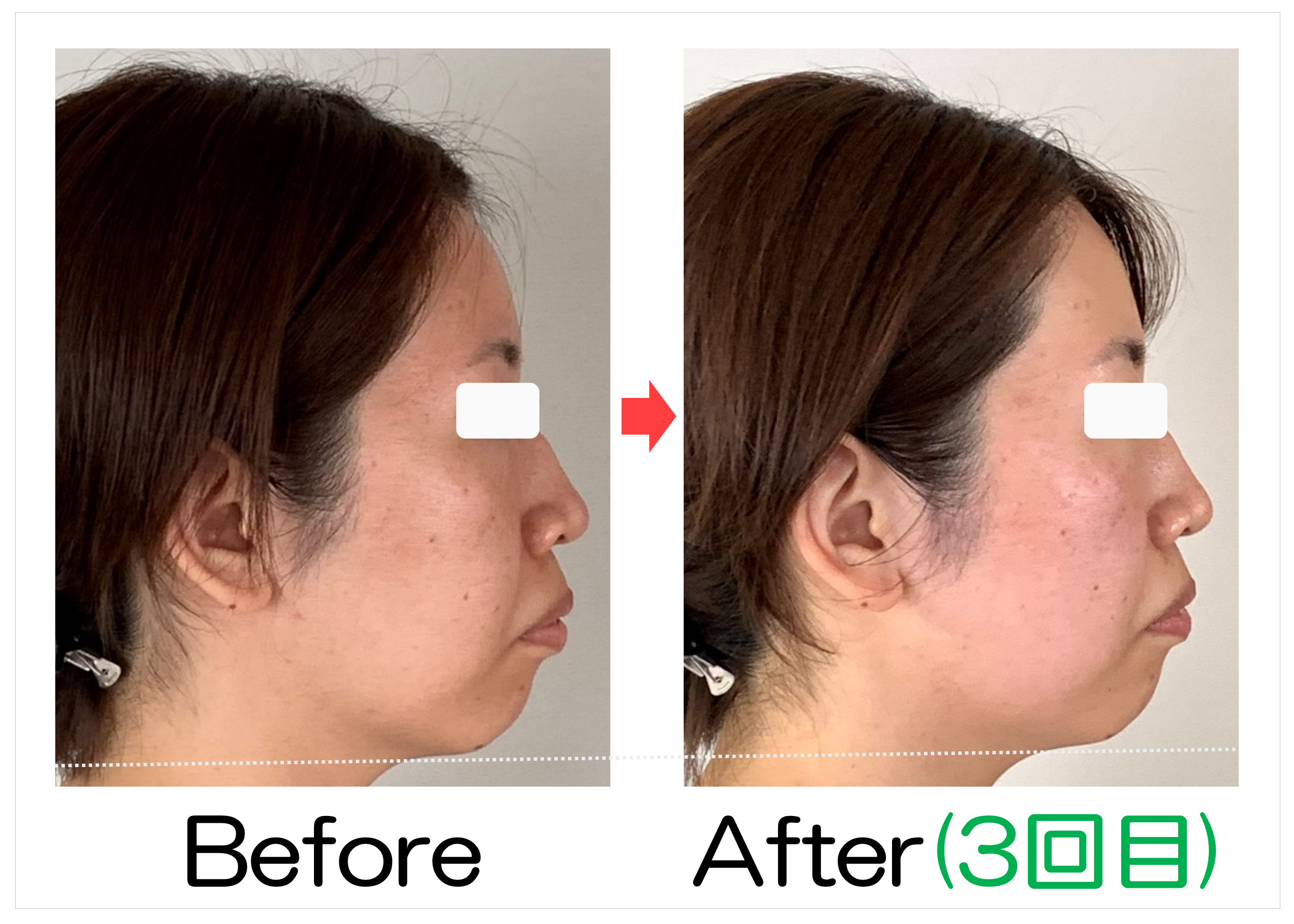 頬からあごの横顔のBefore・After(3回目)比較