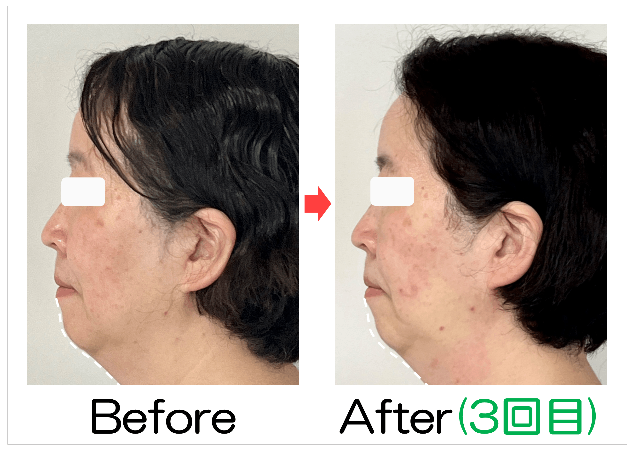 50代女性のあご下と横顔Before・After(3回目)比較