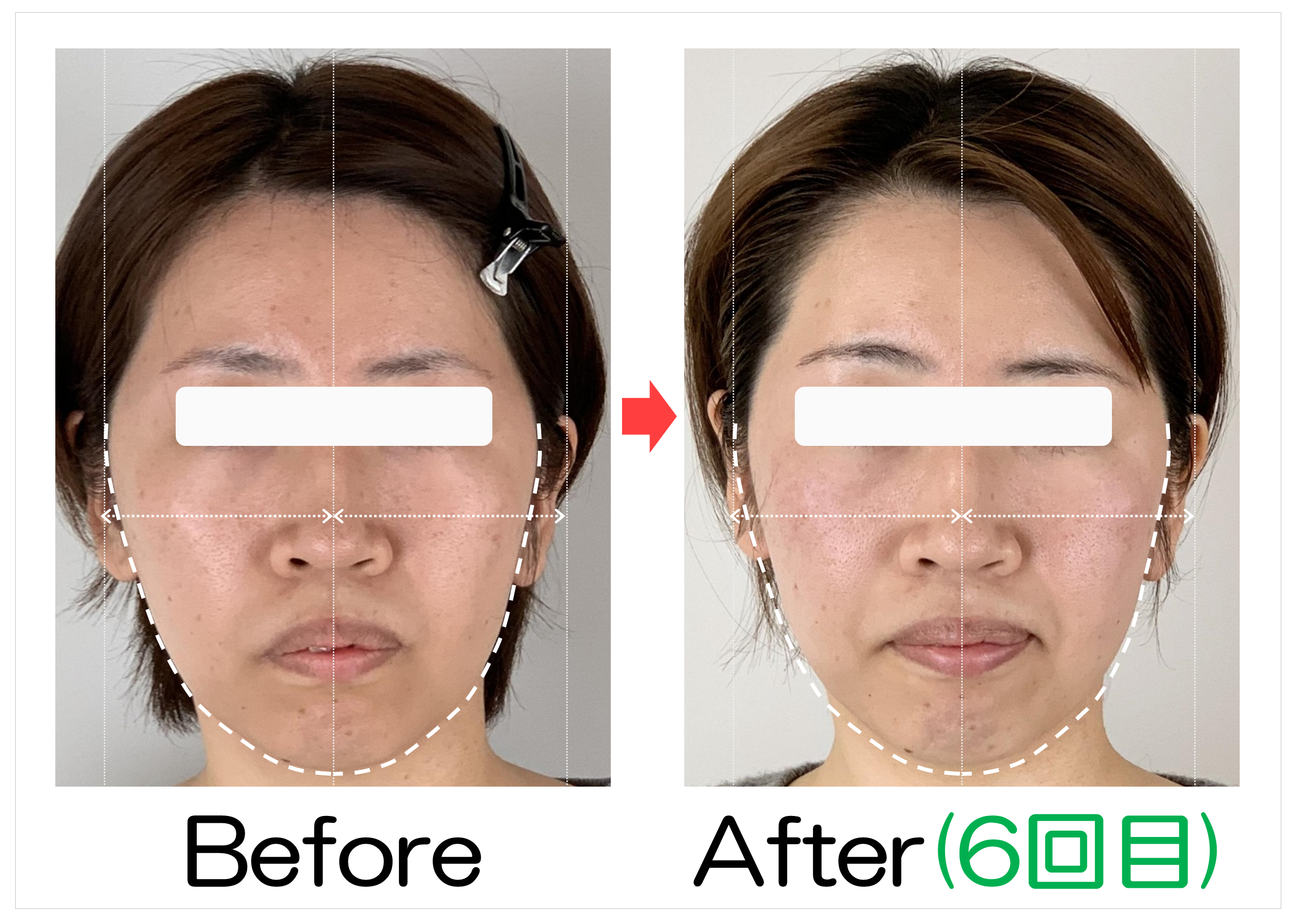 輪郭の左右差とフェイスラインのBefore・After(6回目)比較