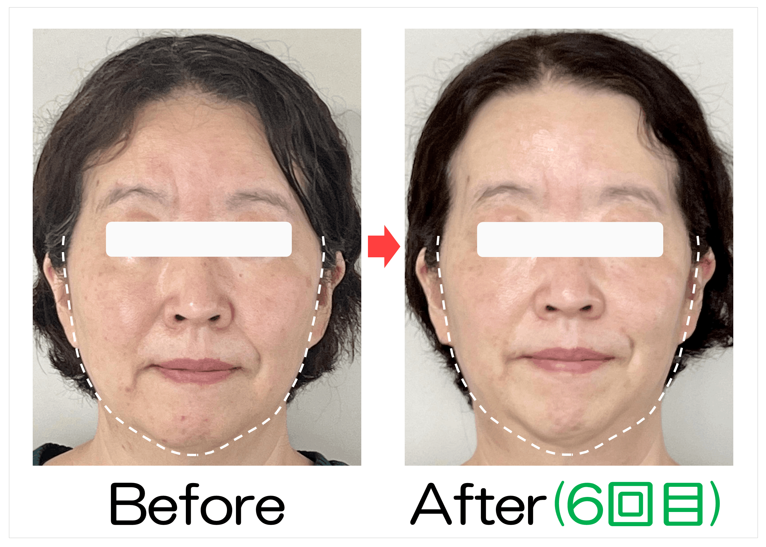 50代女性のフェイスラインBefore・After(6回目)比較