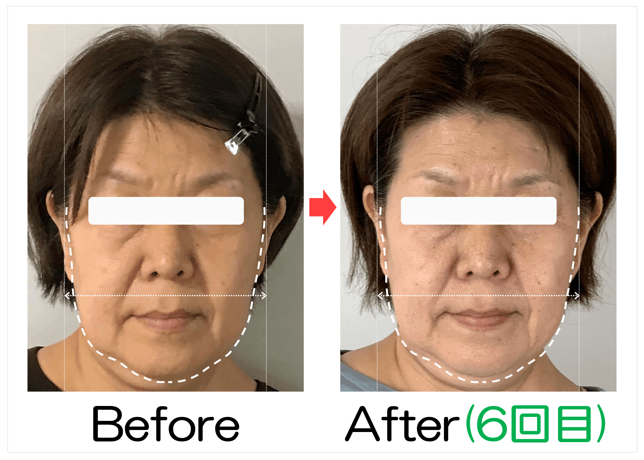 フェイスラインと輪郭のBefore・After(6回目)比較