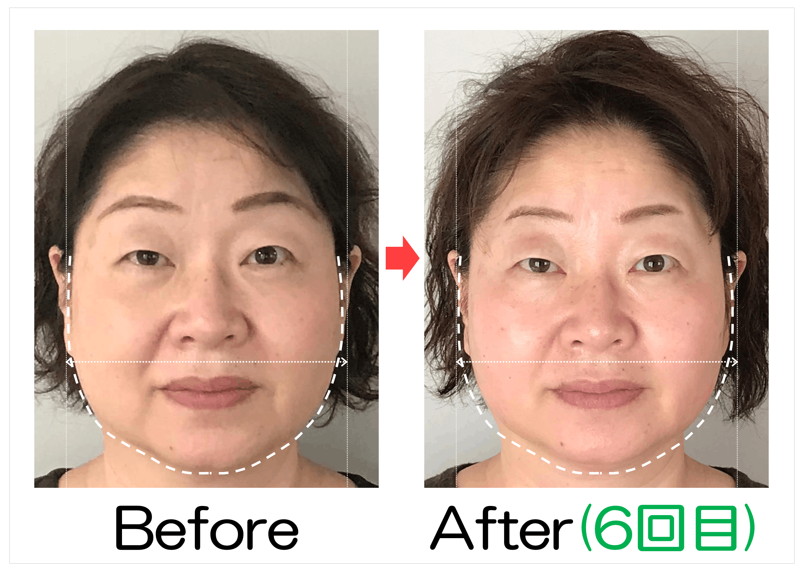 頬の広がりとフェイスラインのBefore・After(6回目)比較