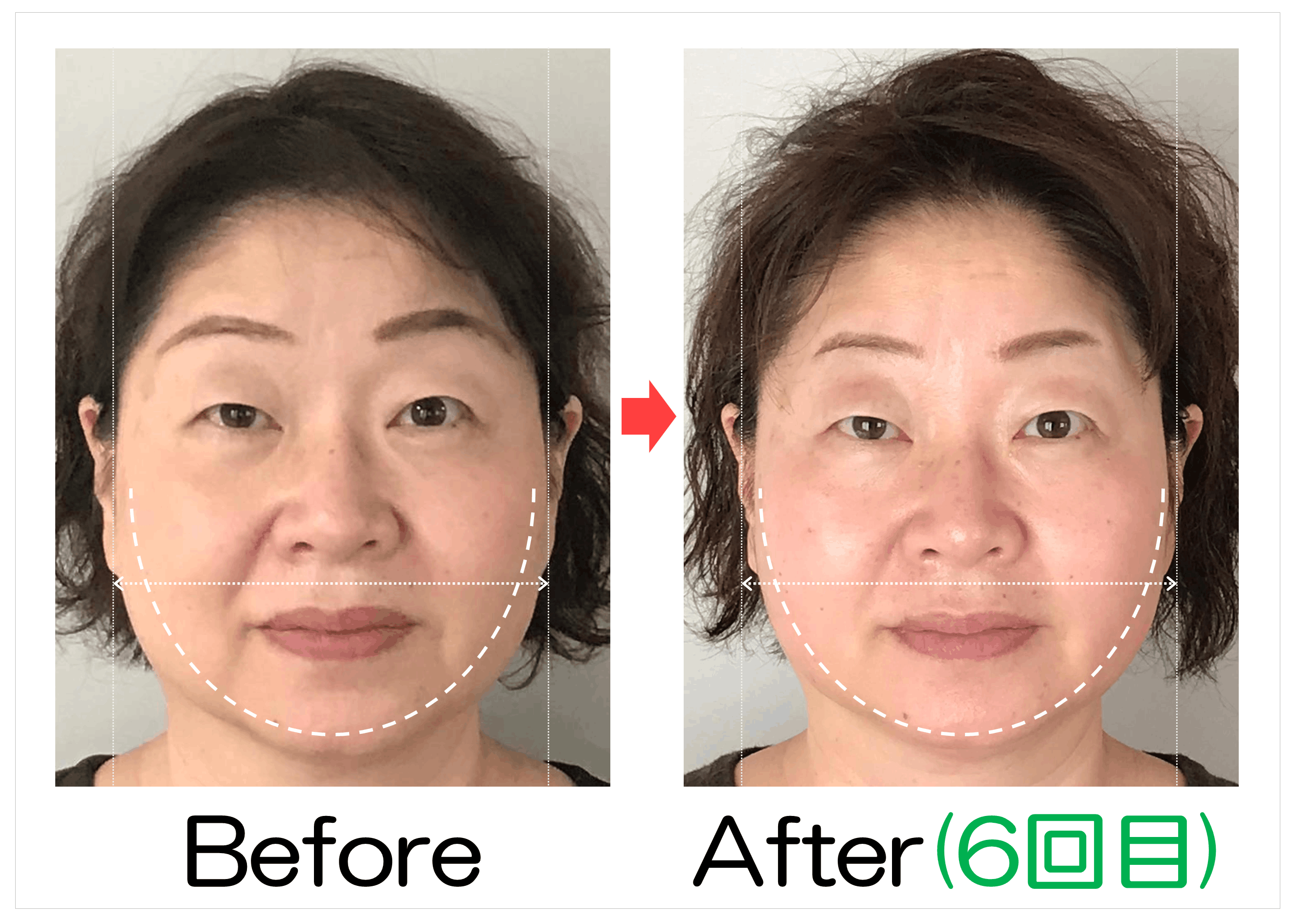 頬からあごの輪郭と卵型ラインのBefore・After(6回目)比較