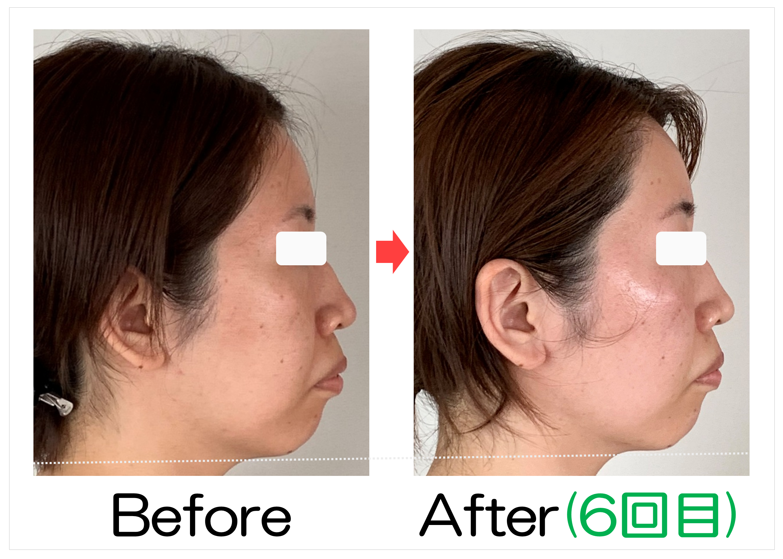 頬からあごの横顔のBefore・After(6回目)比較