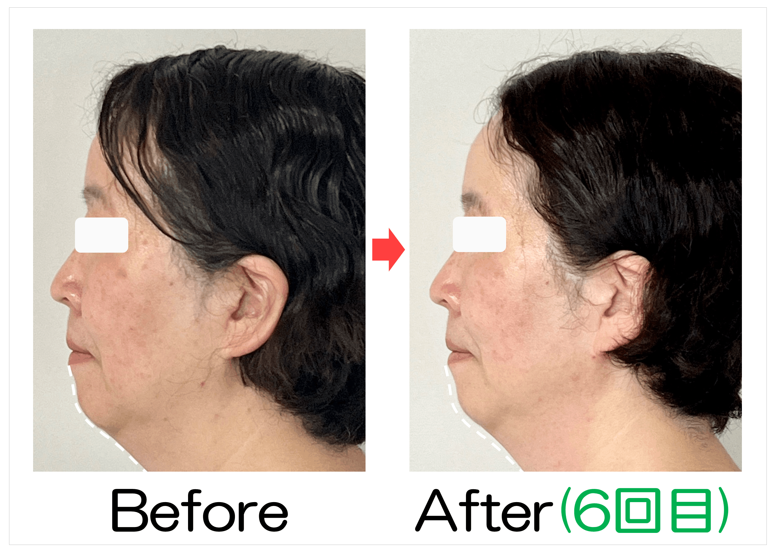 50代女性のあご下と横顔Before・After(6回目)比較