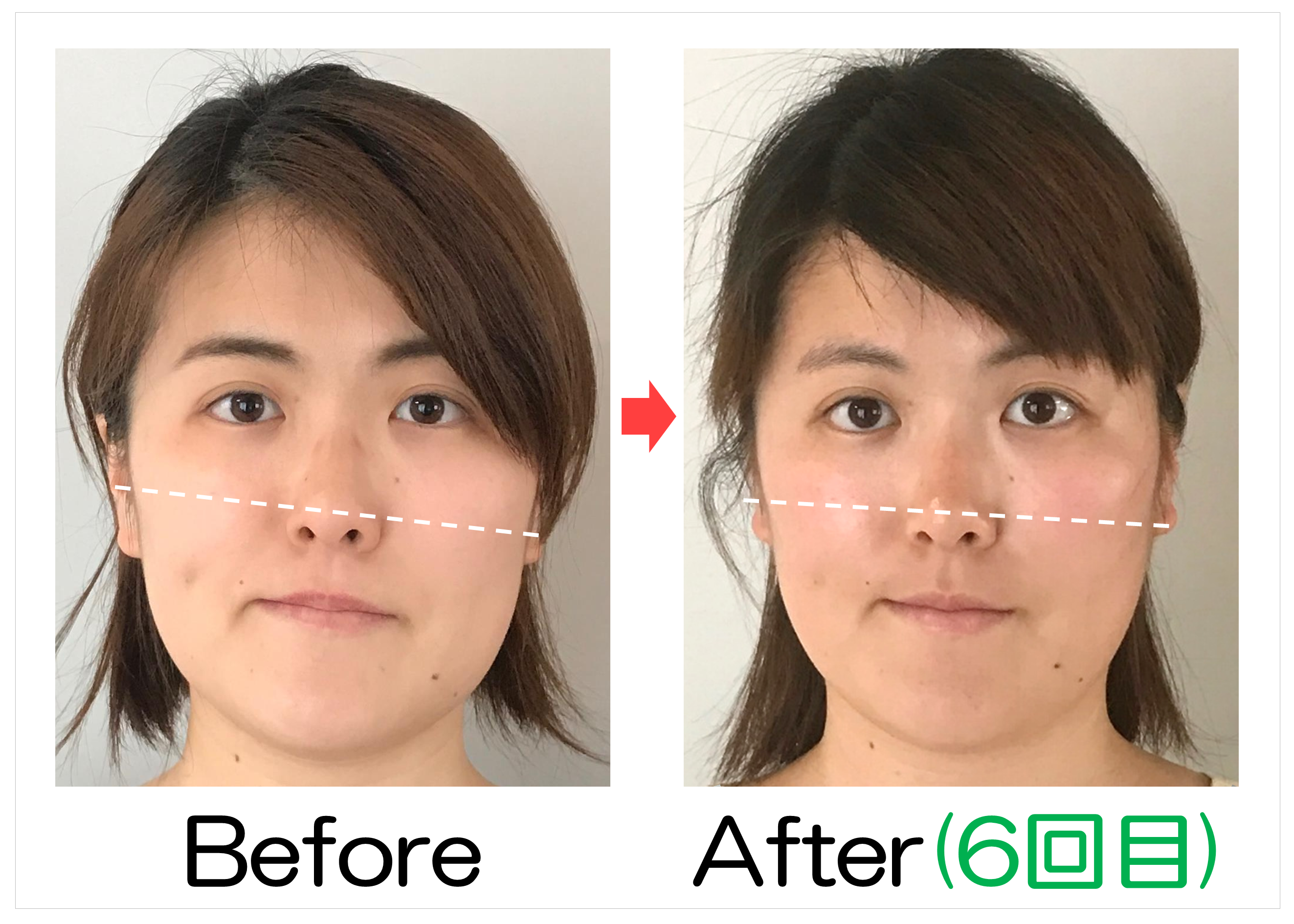 左右の頬の高さのBefore・After(6回目)比較
