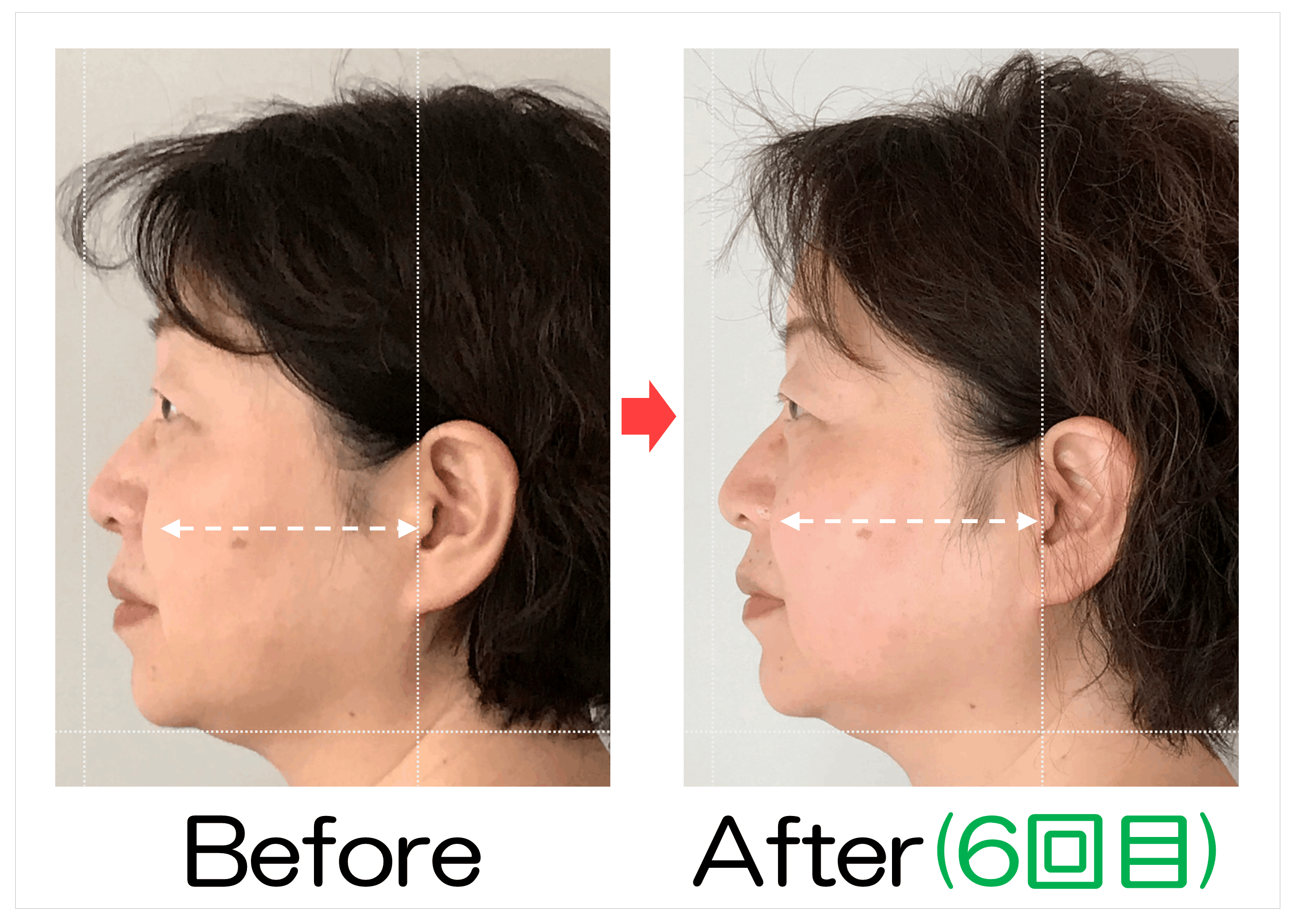 頬からあごの横顔のBefore・After(6回目)比較