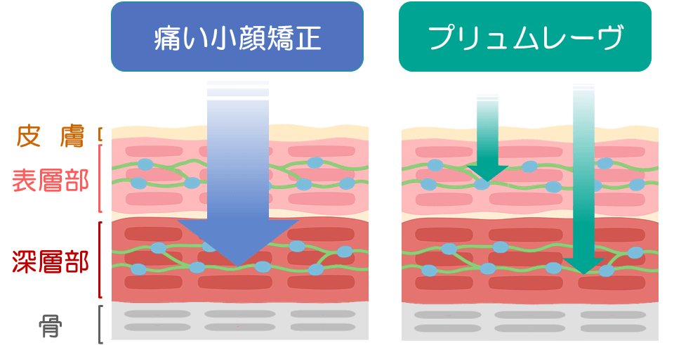 小顔矯正の施術の強さの違い