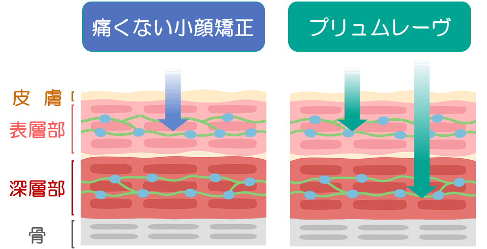 プリュムレーヴの小顔矯正の特徴
